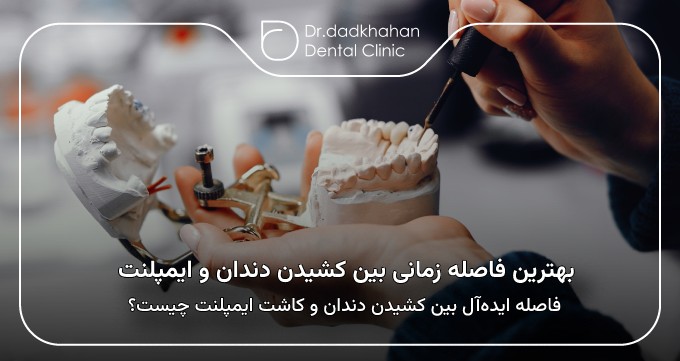 بهترین فاصله زمانی بین کشیدن دندان و ایمپلنت