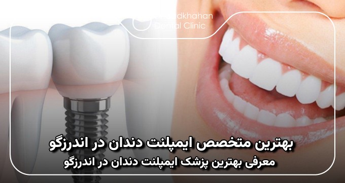 بهترین متخصص ایمپلنت دندان در اندرزگو
