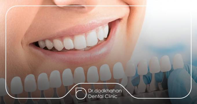 چگونه بهترین دکتر لمینت دندان در تهران را پیدا کنیم؟