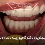 بهترین دکتر کامپوزیت در تهران ❤【سال1404】🦷