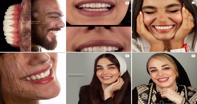 اهمیت مشاوره قبل از انجام لمینت دندان