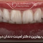 بهترین دکتر لمینت دندان در تهران ✅【سال1404】🦷