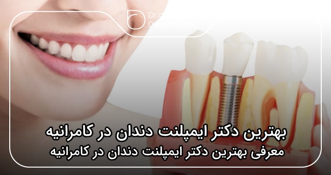 بهترین دکتر ایمپلنت دندان در کامرانیه