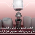جراحی لیفت سینوس قبل از ایمپلنت دندان ❤【سال1404】🦷