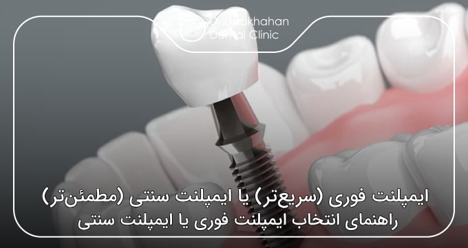 ایمپلنت فوری (سریع‌تر) یا ایمپلنت سنتی (مطمئن‌تر)