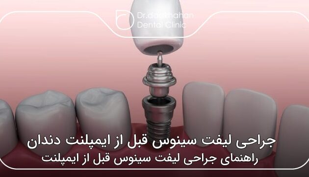 جراحی لیفت سینوس قبل از ایمپلنت دندان