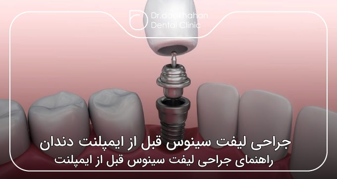 جراحی لیفت سینوس قبل از ایمپلنت دندان