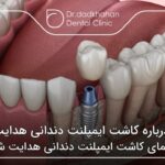 نکاتی درباره کاشت ایمپلنت دندانی هدایت شده  🦷【سال1404】✅