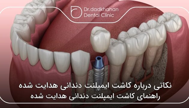 نکاتی درباره کاشت ایمپلنت دندانی هدایت شده 