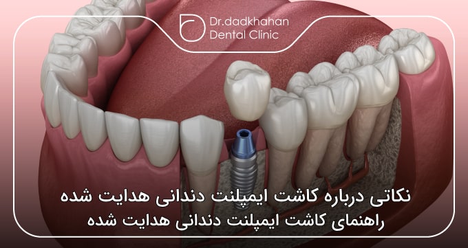 نکاتی درباره کاشت ایمپلنت دندانی هدایت شده 