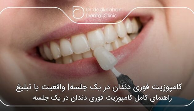 کامپوزیت فوری دندان در یک جلسه