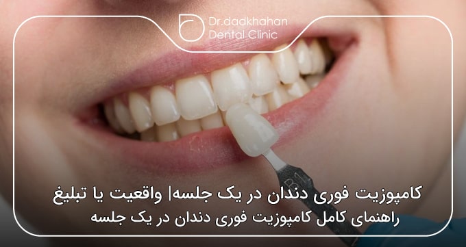 کامپوزیت فوری دندان در یک جلسه
