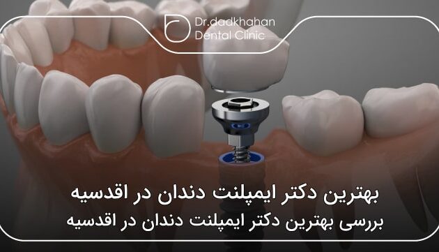 بهترین دکتر ایمپلنت دندان در اقدسیه