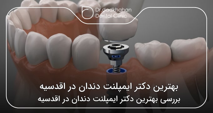 بهترین دکتر ایمپلنت دندان در اقدسیه