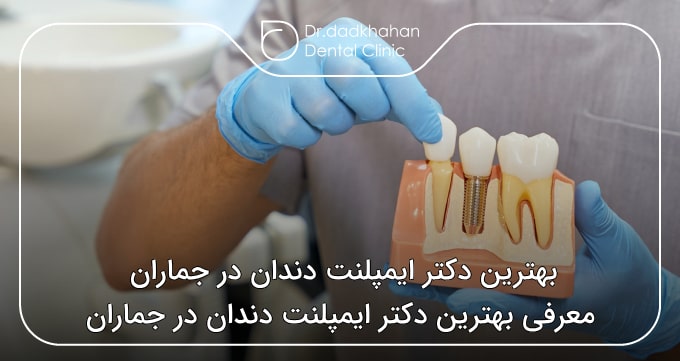 بهترین دکتر ایمپلنت دندان در جماران