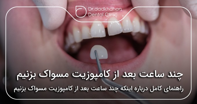 چند ساعت بعد از کامپوزیت مسواک بزنیم✅【سال1404】🦷