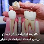 هزینه ایمپلنت در تهران ✅【سال1404】🦷
