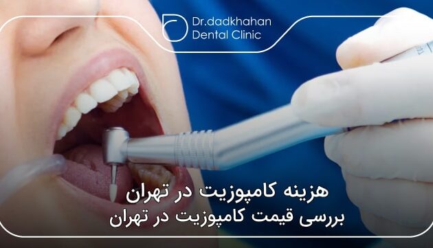 هزینه کامپوزیت در تهران