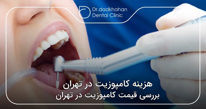 هزینه کامپوزیت در تهران