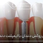 فرق روکش دندان با ايمپلنت دندان⚡【سال1404】🦷