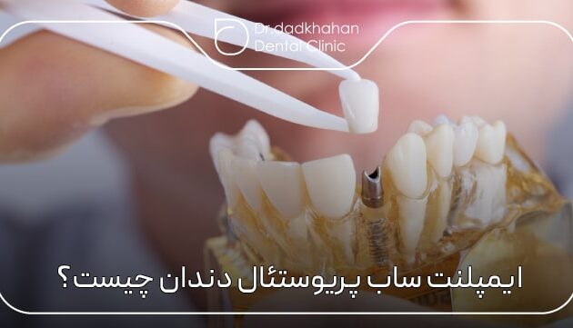 ایمپلنت ساب پریوستئال دندان چیست؟