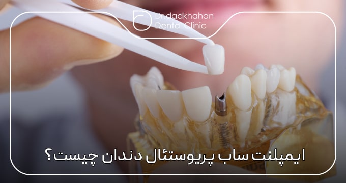 ایمپلنت ساب پریوستئال دندان چیست؟