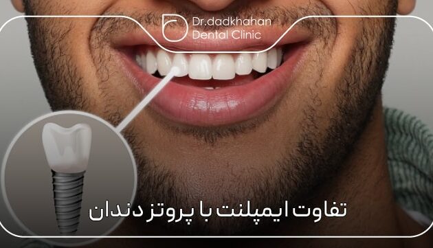 تفاوت ایمپلنت با پروتز دندان