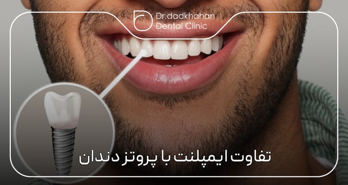 تفاوت ایمپلنت با پروتز دندان