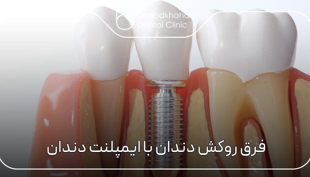 فرق روکش دندان با ایمپلنت دندان