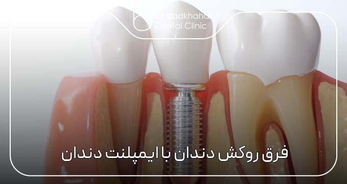 فرق روکش دندان با ایمپلنت دندان