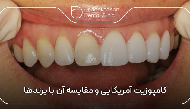کامپوزیت آمریکایی و مقایسه آن با برندهای اروپایی و آسیایی