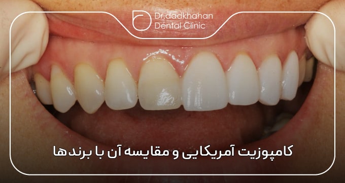 کامپوزیت آمریکایی و مقایسه آن با برندهای اروپایی و آسیایی