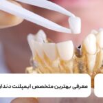 بهترین متخصص ایمپلنت دندان در تهران 🦷【سال1404】✅