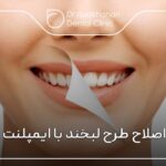 اصلاح طرح لبخند با ایمپلنت ✅【سال1404】🦷