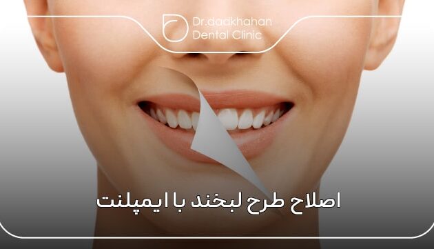اصلاح طرح لبخند با ایمپلنت