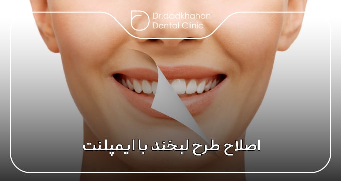 اصلاح طرح لبخند با ایمپلنت