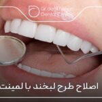 اصلاح طرح لبخند با لمینت ✅【سال1404】🦷