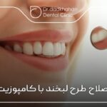 اصلاح طرح لبخند با کامپوزیت ⭐【سال1404】🦷