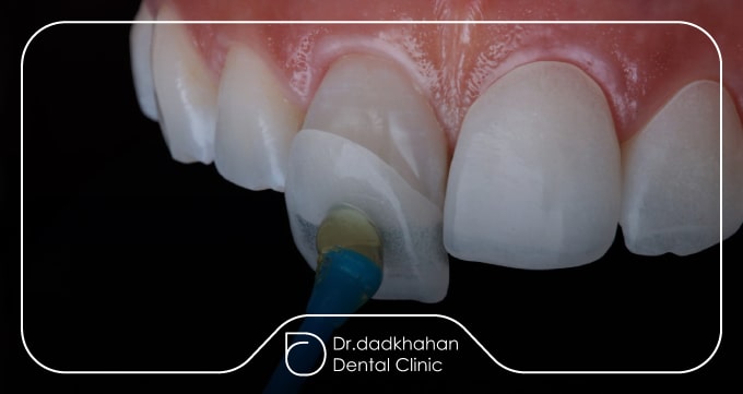 چه تعداد دندان در طرح لبخند باید کامپوزیت یا لمینت شوند؟