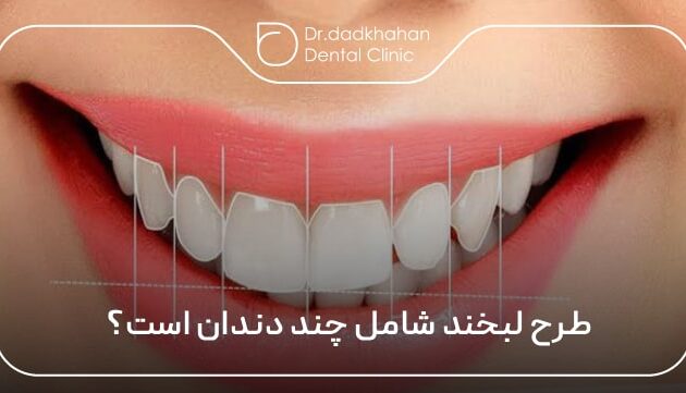 طرح لبخند شامل چند دندان است؟ تعداد دقیق برای لمینت و کامپوزیت 