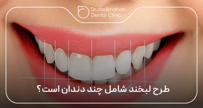 طرح لبخند شامل چند دندان است؟ تعداد دقیق برای لمینت و کامپوزیت 