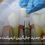 ۴ روش جدید جایگزین ایمپلنت دندان ⭐【سال1404】🦷