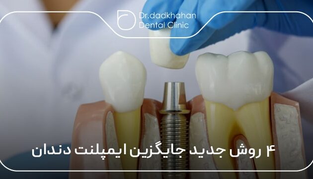 ۴ روش جدید جایگزین ایمپلنت دندان