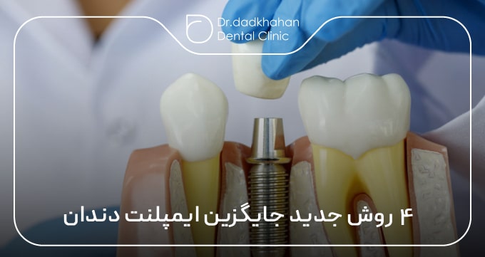 ۴ روش جدید جایگزین ایمپلنت دندان