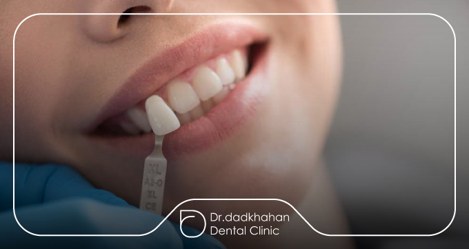 روند تعویض لمینت