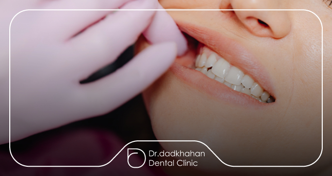 آماده‌سازی دندان‌ها قبل از نصب لمینت