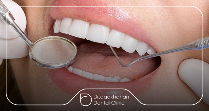 لمینت چگونه کجی و نامرتبی‌های خفیف را اصلاح می‌کند؟