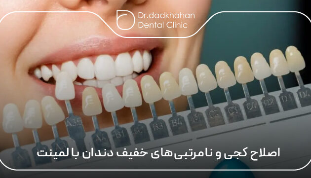 اصلاح کجی و نامرتبی‌های خفیف دندان با لمینت