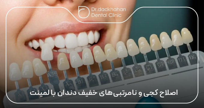 اصلاح کجی و نامرتبی‌های خفیف دندان با لمینت