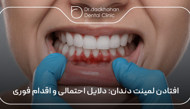 افتادن لمینت دندان: دلایل احتمالی و اقدام فوری